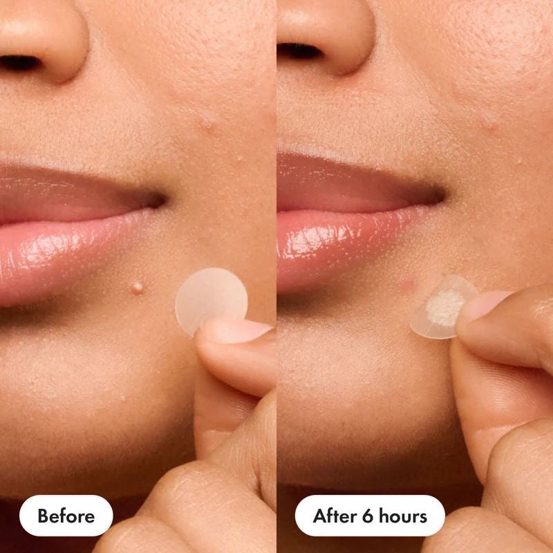 ⭐ Star-Shaped Hydrocolloid Pimple Patches – Colorful Acne Spot Treatment